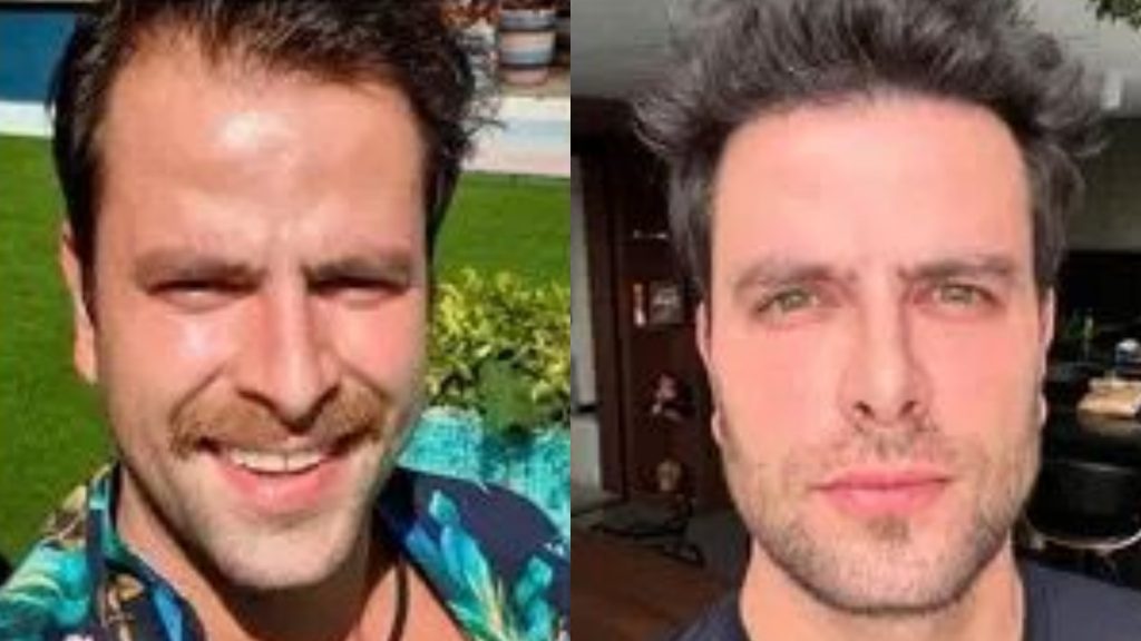 Transformação radical de Gustavo Marsengo após harmonização facial viraliza; veja fotos de famosos que também chamaram atenção